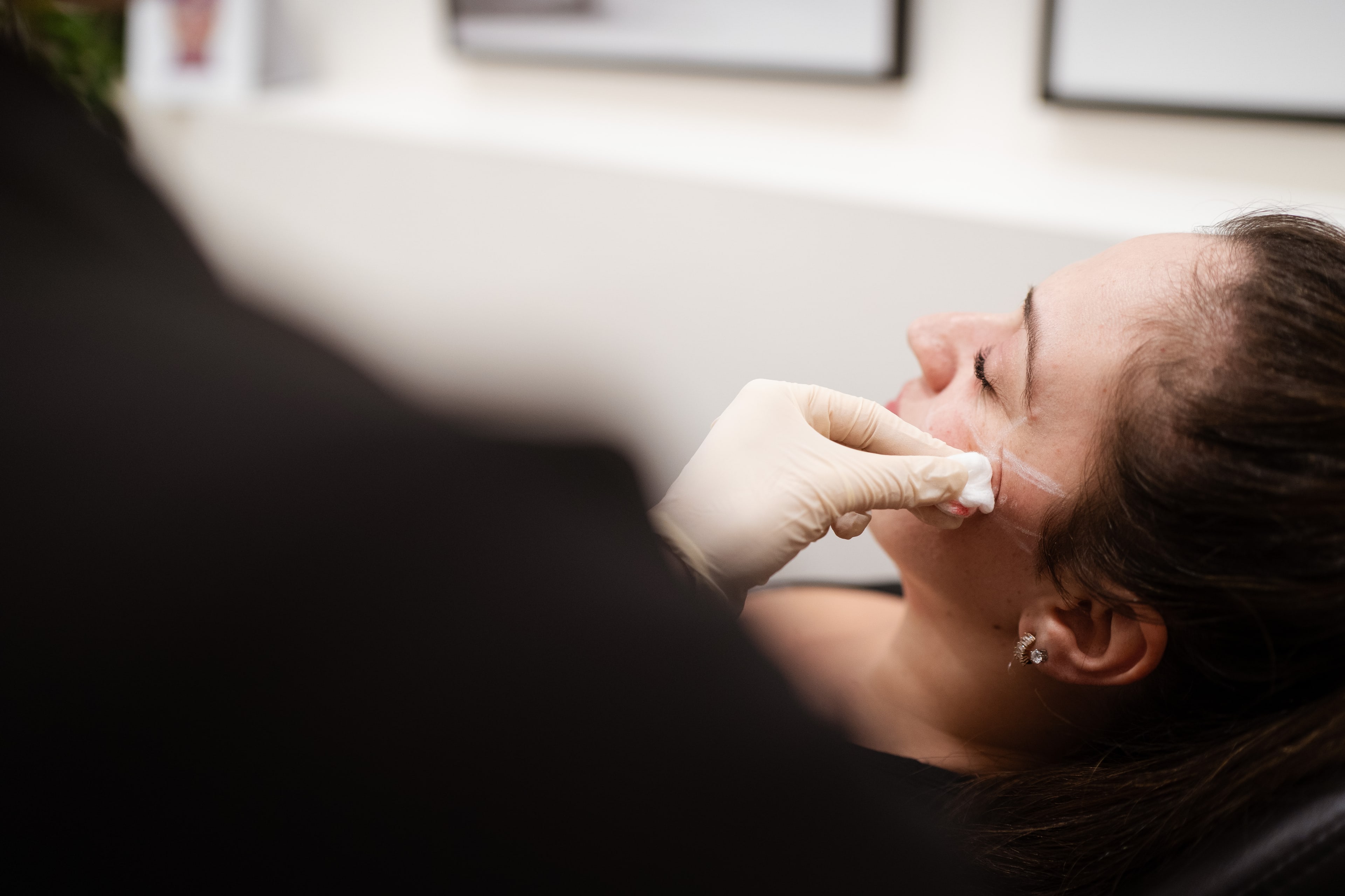 Gloved clinician wipes cleansing product from a reclining female client's cheek during a facial skin treatment at Evolution Laser Clinic.
